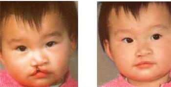 成人唇裂整形视频过程图,成人唇裂整形手术全过程解析